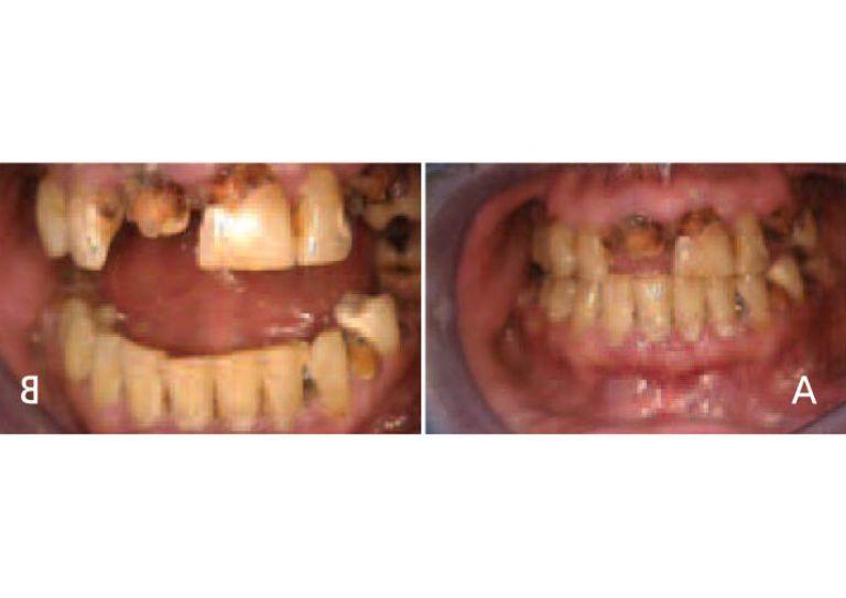 Oral manifestations in the advanced states of methamphetamine abuse include A) teeth broken off at the gingival margin; and B) grayish-brown dentition with enamel that is reduced to a soft leathery texture, 还有牙龈炎和急性牙周炎.