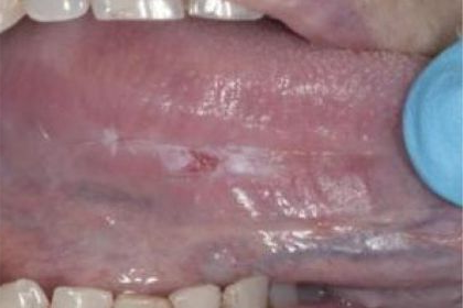 Leukoplakia. 最常见的癌前病变(89%:618/695)