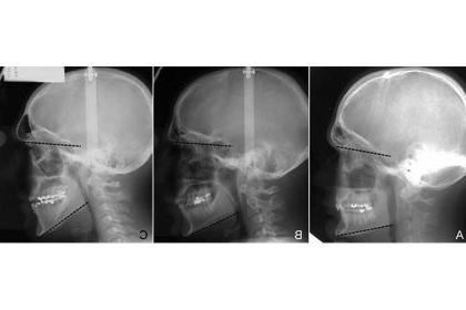 Lateral cephalograms demonstrating examples of hypo‐divergent (A), normo‐divergent (B) and hyper‐divergent (C) facial types.