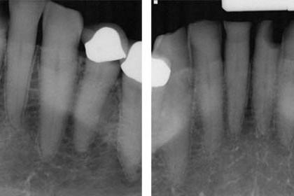 Radiograph of distal D3 approximal lesion on tooth #25. The technique known as SMART could help repair tooth damage and prevent caries without requiring multiple appointments.